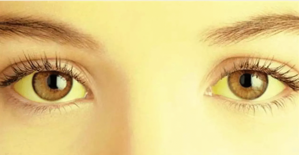 Student Dies of Jaundice: स्कूल में गंदा पानी पीने से छात्रा की मौत, स्वास्थ्य तंत्र पर खड़े हुए सवाल